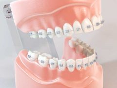 メタルブラケットによる歯列矯正がされてる歯の模型