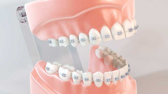 メタルブラケットによる歯列矯正がされてる歯の模型